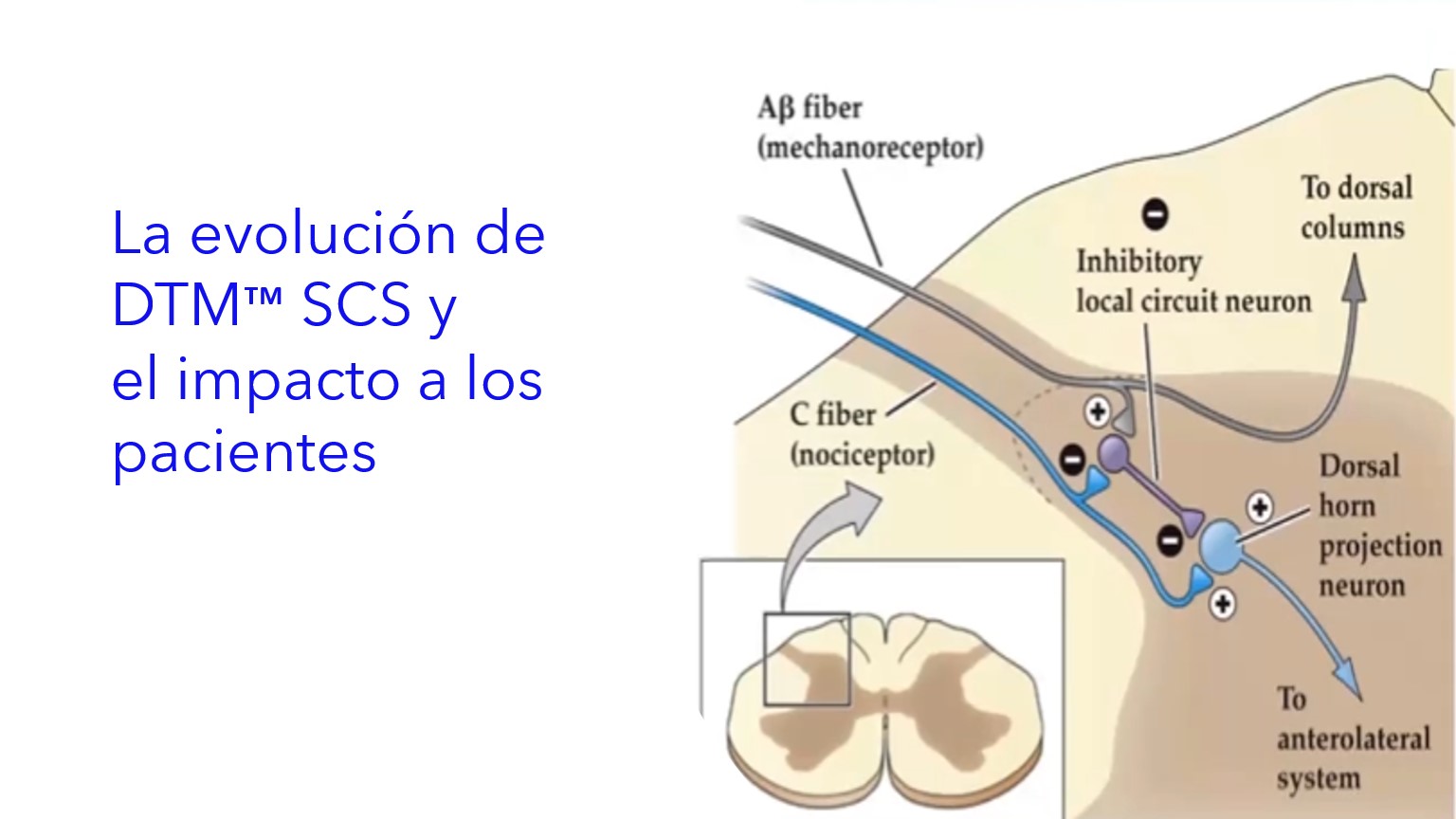 Componentes del Sistema de Terapia Intratecal de Baclofeno.