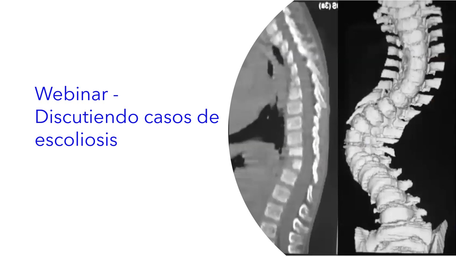Webinar - Discutiendo Casos de Escoliosis | Webinar - Discutindo Casos de Escoliose